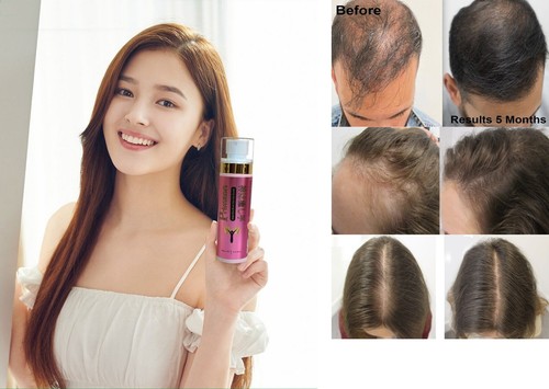 Hair loss baldness serum for - baldness,